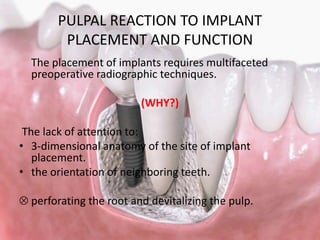 PULPAL REACTION TO IMPLANT
PLACEMENT AND FUNCTION
It is usually recommended to place theimplants at a site
free of perirad...