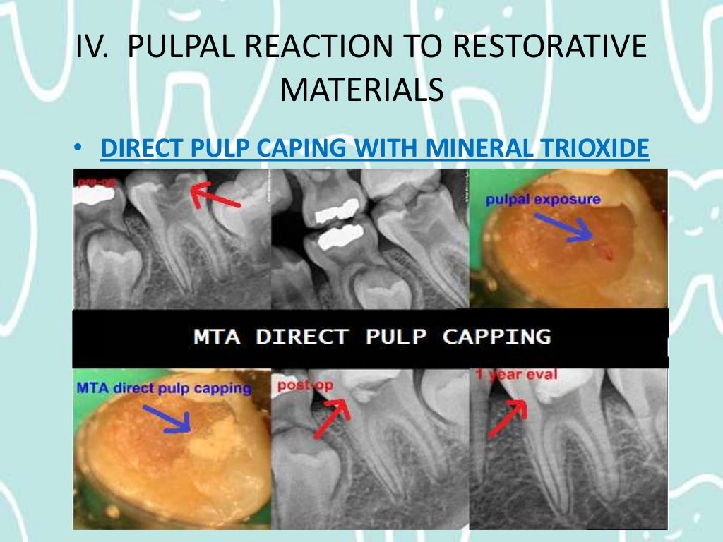 Pulpal Reactions to Dental Caries and Dental Proceudres
