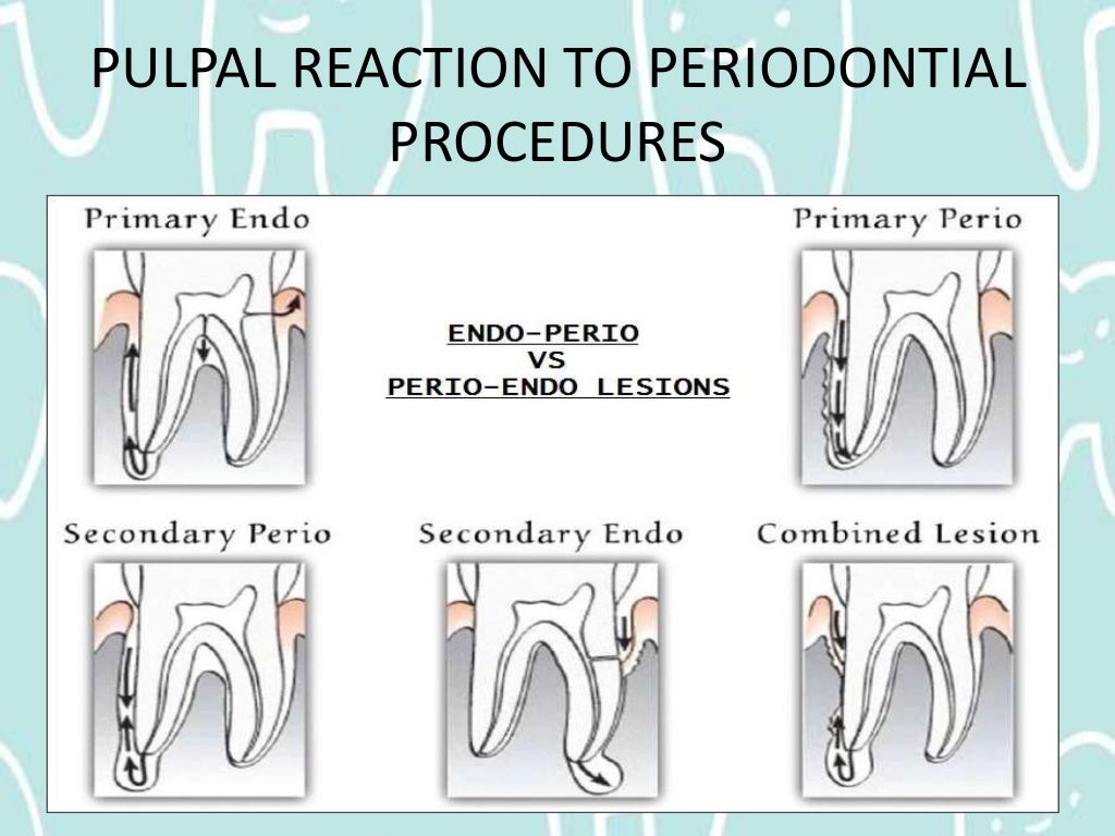 Pulpal Reactions to Dental Caries and Dental Proceudres