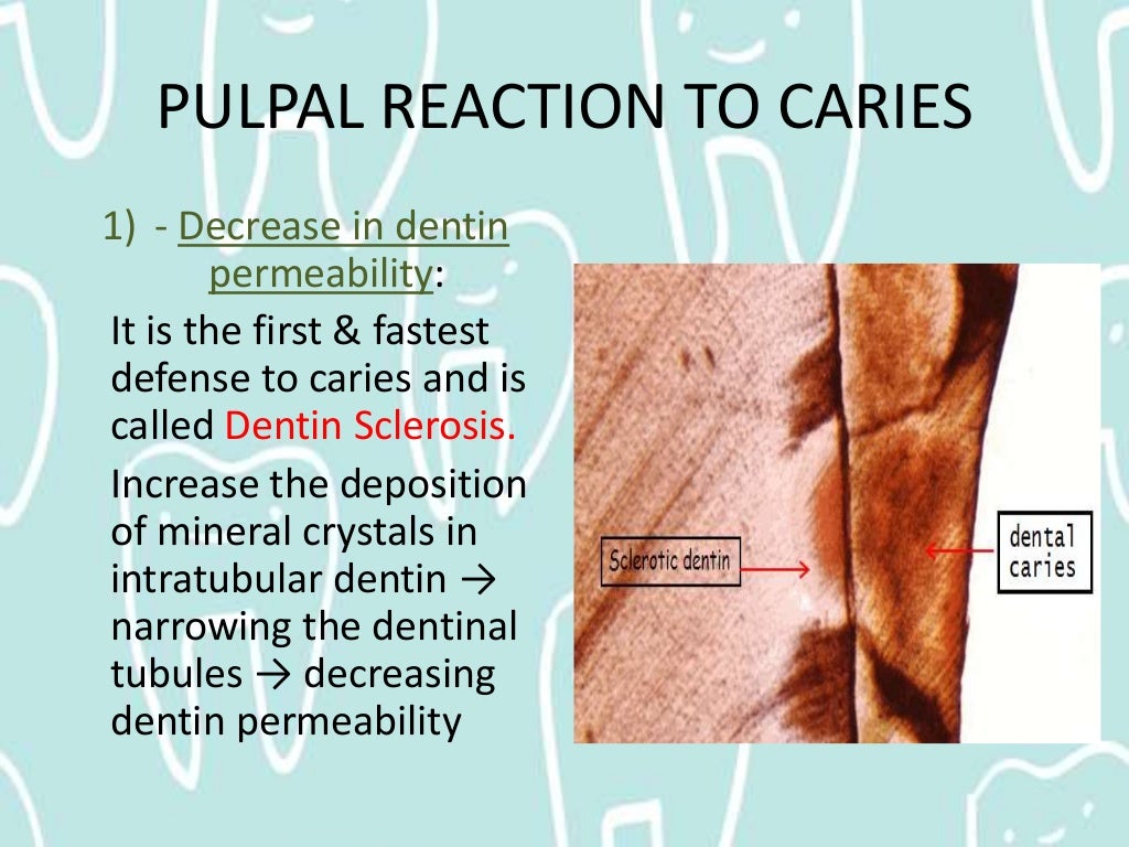 Pulpal Reactions to Dental Caries and Dental Proceudres