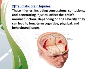 2)Traumatic Brain Injuries:
These injuries, including concussions, contusions,
and penetrating injuries, affect the brain’s
normal function. Depending on the severity, they
can lead to long-term cognitive, physical, and
behavioural issues.
 
