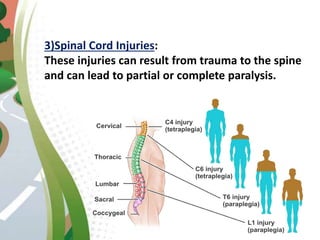 3)Spinal Cord Injuries:
These injuries can result from trauma to the spine
and can lead to partial or complete paralysis.
 