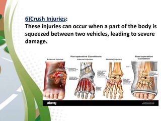6)Crush Injuries:
These injuries can occur when a part of the body is
squeezed between two vehicles, leading to severe
damage.
 