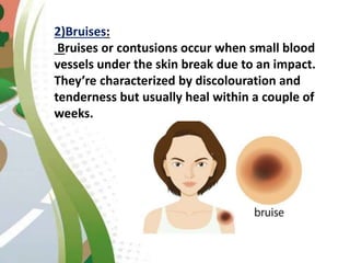2)Bruises:
Bruises or contusions occur when small blood
vessels under the skin break due to an impact.
They’re characterized by discolouration and
tenderness but usually heal within a couple of
weeks.
 