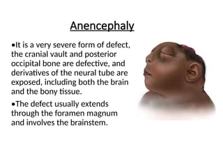 Brainless Child Congenital anomalies and birth injuries in newborn.pptx