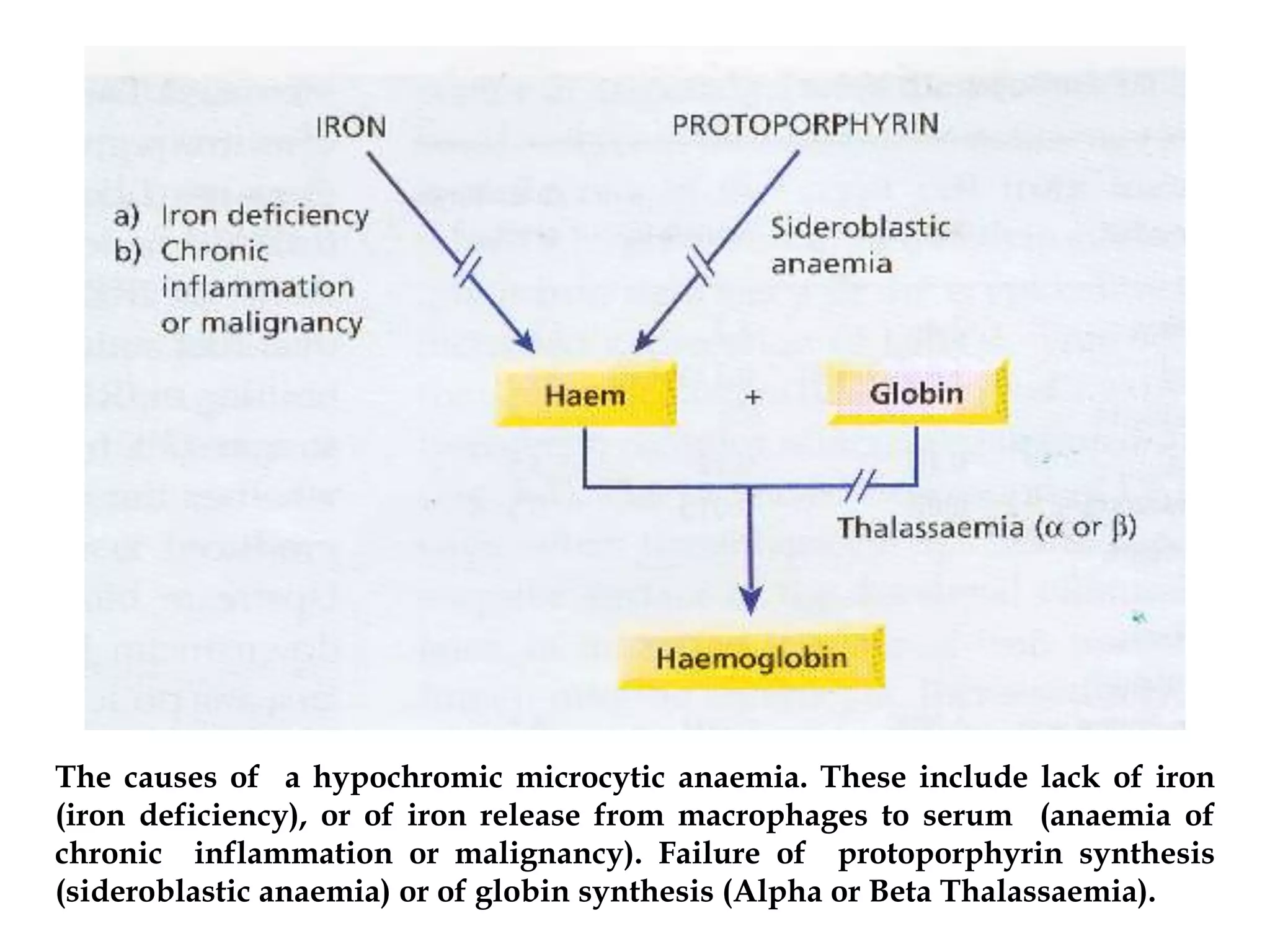 The causes of a hypochromic microcytic anaemia. These include lack of iron 
(iron deficiency), or of iron release from macrophages to serum (anaemia of 
chronic inflammation or malignancy). Failure of protoporphyrin synthesis 
(sideroblastic anaemia) or of globin synthesis (Alpha or Beta Thalassaemia). 
 