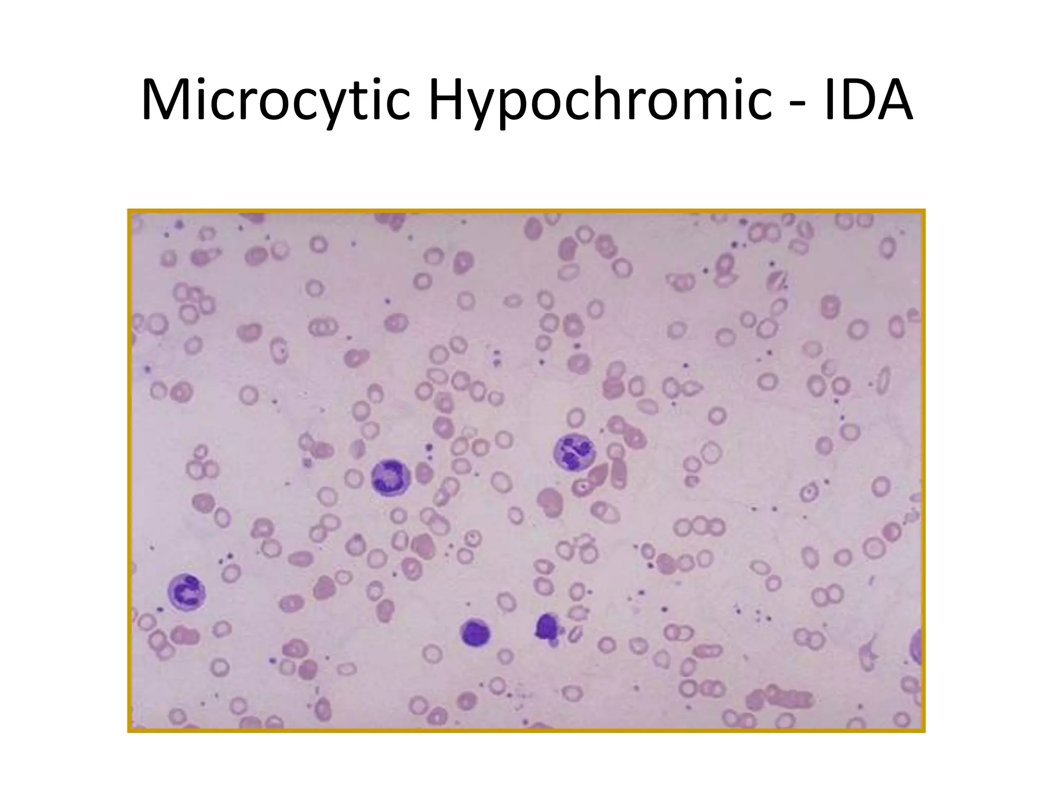 Microcytic Hypochromic - IDA 
 
