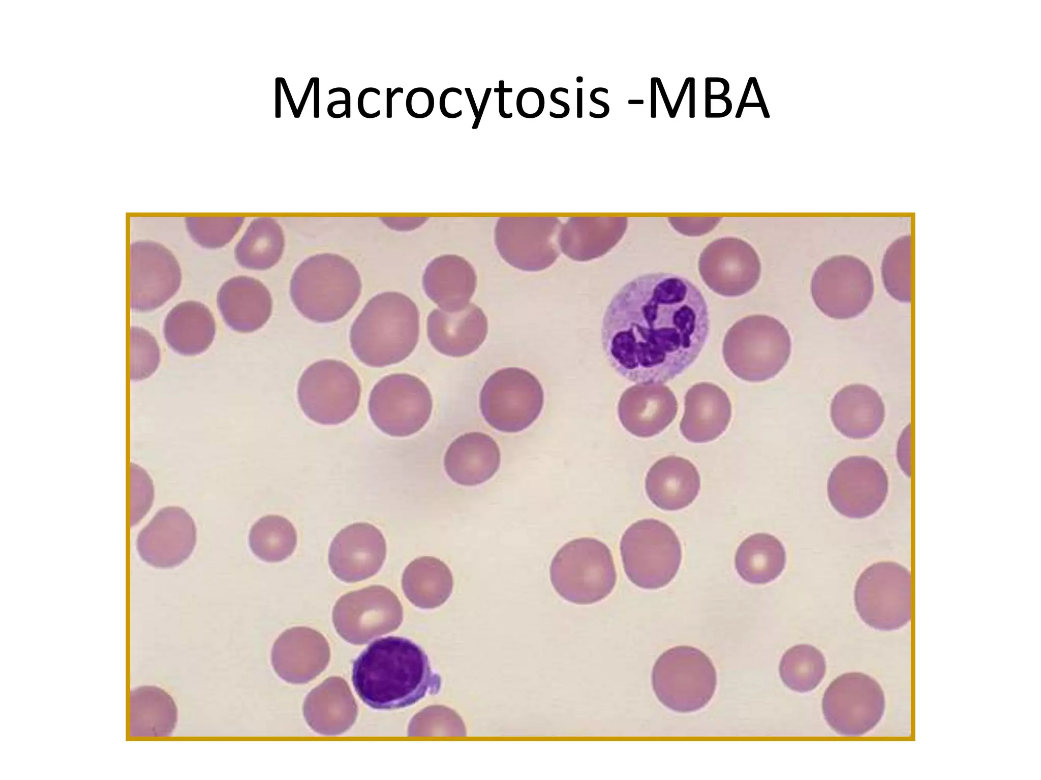 Macrocytosis -MBA 
 