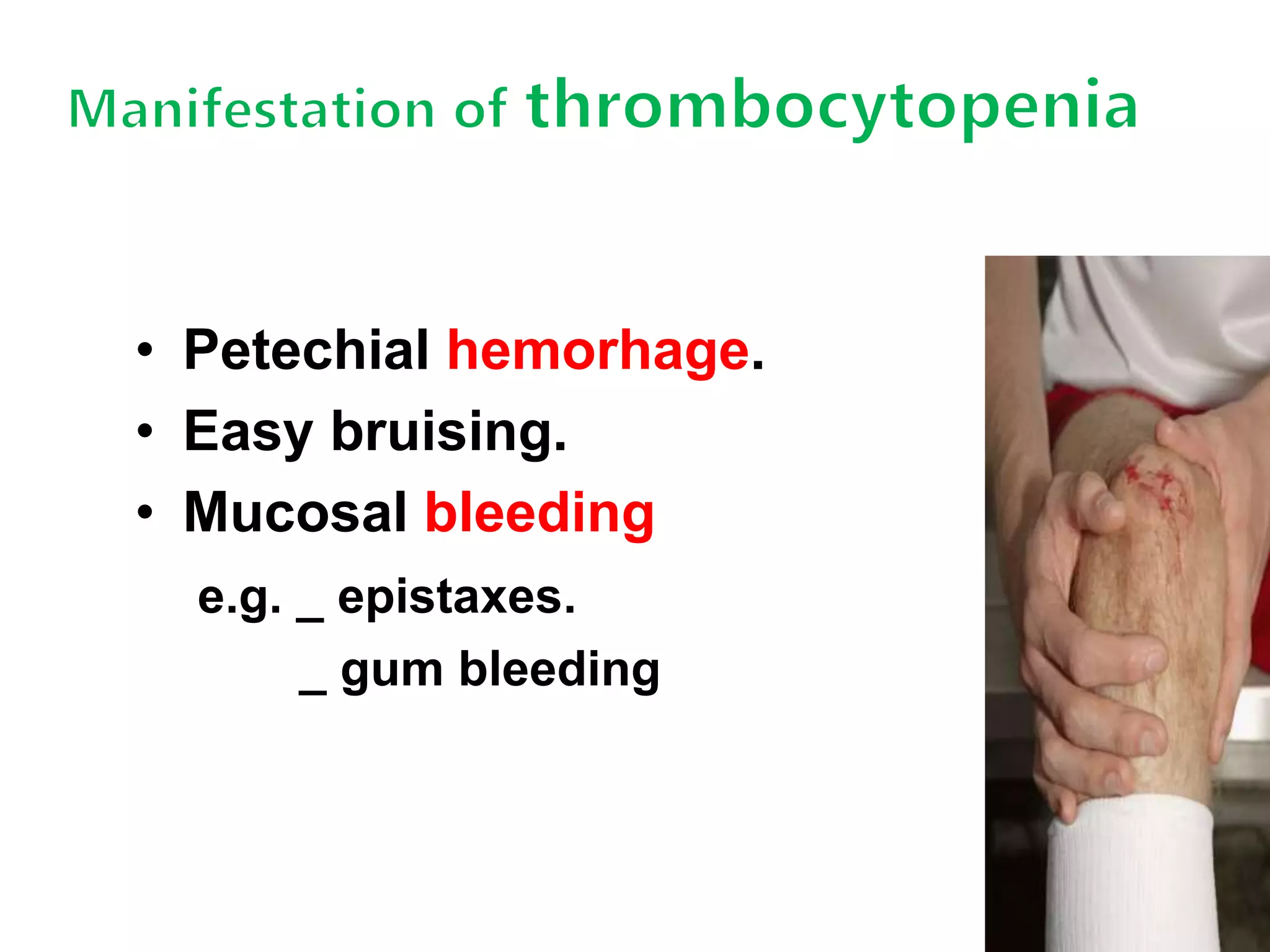 • Petechial hemorhage. 
• Easy bruising. 
• Mucosal bleeding 
e.g. _ epistaxes. 
_ gum bleeding 
 