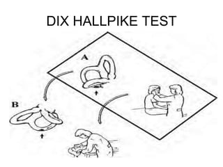 DIX HALLPIKE TEST
 