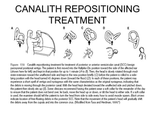 CANALITH REPOSITIONING
TREATMENT
 