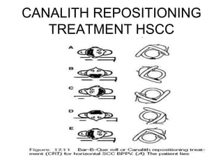 CANALITH REPOSITIONING
TREATMENT HSCC
 
