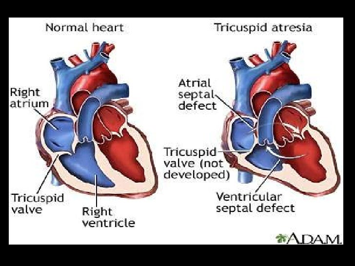 tricuspid atresia