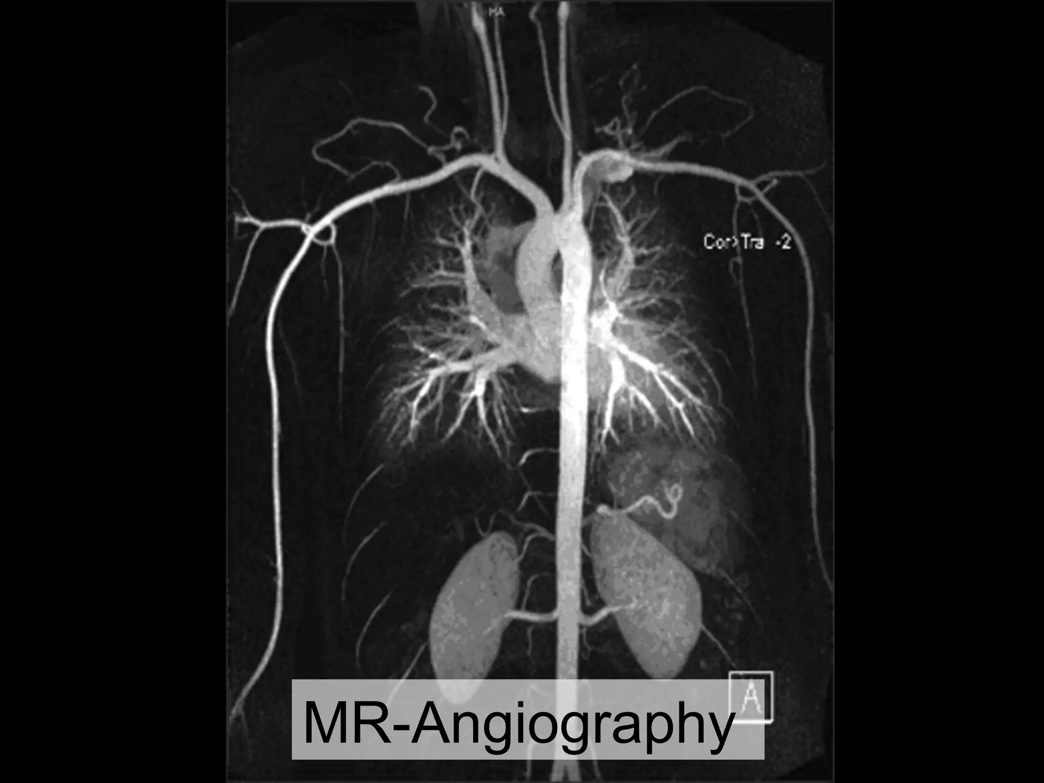 Peripheral arterial occlusive disease | PPT