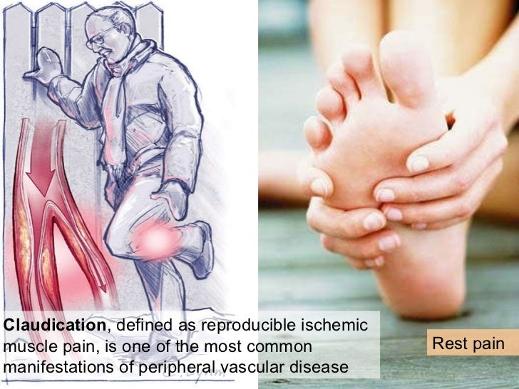 Peripheral Arterial Occlusive Disease peripheral-arterial-occlusive-disease