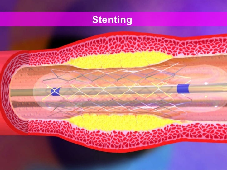 Peripheral arterial occlusive disease