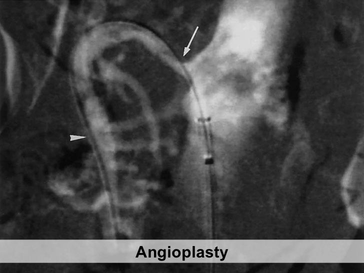 Peripheral arterial occlusive disease