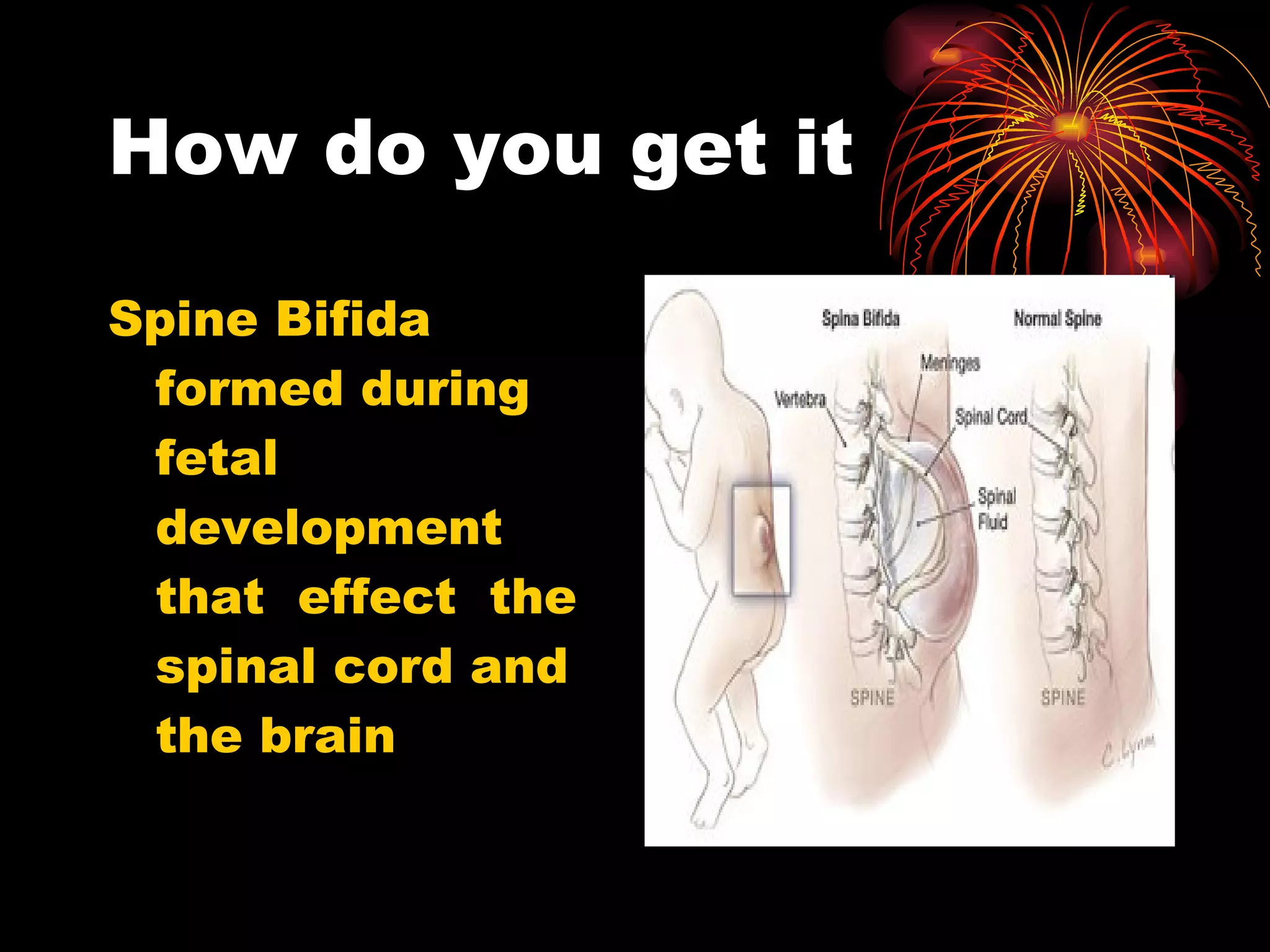 How do you get it Spine Bifida formed during fetal development that effect the spinal cord and the brain