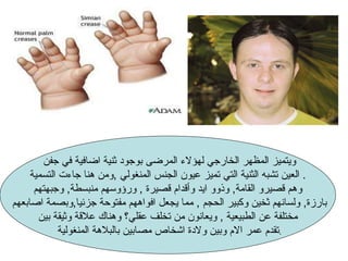 ويتميز المظهر الخارجي لهؤلاء المرضى بوجود ثنية اضافية في جفن  العين تشبه الثنية التي تميز عيون الجنس المنغولي  , ومن هنا جاءت التسمية .  وهم قصيرو القامة ,  وذوو ايد وأقدام قصيرة  ,  ورؤوسهم منبسطة ,  وجبهتهم بارزة ,  ولسانهم ثخين وكبير الحجم  ,  مما يجعل افواههم مفتوحة جزئيا , وبصمة اصابعهم  مختلفة عن الطبيعية  ,  ويعانون من تخلف عقلي؟ وهناك علاقة وثيقة بين تقدم عمر الام وبين ولادة اشخاص مصابين بالبلاهة المنغولية . 