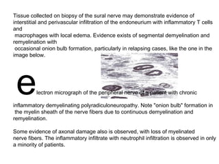 Tissue collected on biopsy of the sural nerve may demonstrate evidence of  interstitial and perivascular infiltration of the endoneurium with inflammatory T cells and macrophages with local edema. Evidence exists of segmental demyelination and remyelination with occasional onion bulb formation, particularly in relapsing cases, like the one in the image below. e lectron micrograph of the peripheral nerve of a patient with chronic  inflammatory demyelinating polyradiculoneuropathy. Note "onion bulb" formation in the myelin sheath of the nerve fibers due to continuous demyelination and remyelination.  Some evidence of axonal damage also is observed, with loss of myelinated  nerve fibers. The inflammatory infiltrate with neutrophil infiltration is observed in only a minority of patients.  