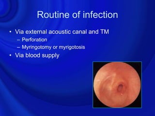 Routine of infection
• Via external acoustic canal and TM
  – Perforation
  – Myringotomy or myrigotosis
• Via blood supply
 