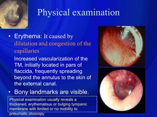 Physical examination

• Erythema: It caused by
  dilatation and congestion of the
  capillaries
  Increased vascularization of the
  TM, initially located in pars of
  flaccida, frequently spreading
  beyond the annulus to the skin of
  the external canal.
• Bony landmarks are visible.
Physical examination usually reveals a
thickened, erythematous or bulging tympanic
membrane with limited or no mobility to
pneumatic otoscopy.
 