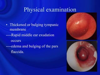 Physical examination

• Thickened or bulging tympanic
   membrane
----Rapid middle ear exudation
    occurs
----edema and bulging of the pars
    flaccida.
 