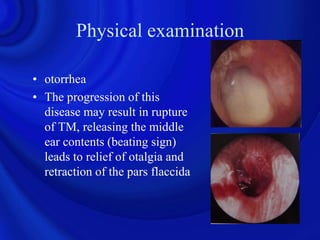 Physical examination

• otorrhea
• The progression of this
  disease may result in rupture
  of TM, releasing the middle
  ear contents (beating sign)
  leads to relief of otalgia and
  retraction of the pars flaccida
 
