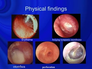 Physical findings




     Erythema           bulging tympanic membrane




otorrhea        perforation
 