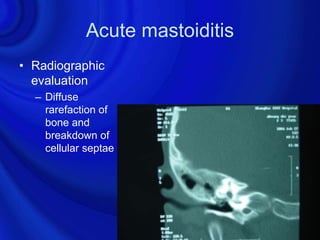 Acute mastoiditis
• Radiographic
  evaluation
  – Diffuse
    rarefaction of
    bone and
    breakdown of
    cellular septae
 