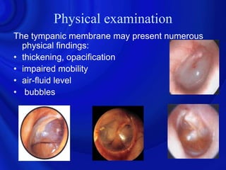 Physical examination
The tympanic membrane may present numerous
  physical findings:
• thickening, opacification
• impaired mobility
• air-fluid level
• bubbles
 