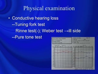 Physical examination
• Conductive hearing loss
  --Tuning fork test
    Rinne test(-); Weber test →ill side
  --Pure tone test
 