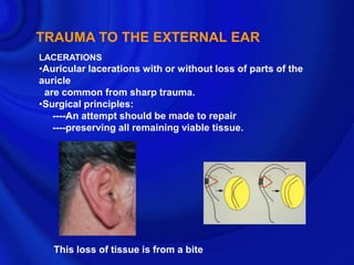TRAUMA TO THE EXTERNAL EAR
LACERATIONS
•Auricular lacerations with or without loss of parts of the
auricle
 are common from sharp trauma.
•Surgical principles:
   ----An attempt should be made to repair
   ----preserving all remaining viable tissue.




   This loss of tissue is from a bite
 