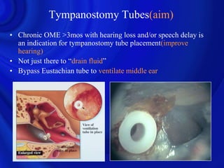 Tympanostomy Tubes(aim)
• Chronic OME >3mos with hearing loss and/or speech delay is
  an indication for tympanostomy tube placement(improve
  hearing)
• Not just there to “drain fluid”
• Bypass Eustachian tube to ventilate middle ear
 