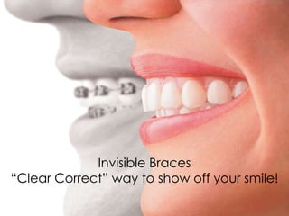 Invisible Braces
“Clear Correct” way to show off your smile!
 