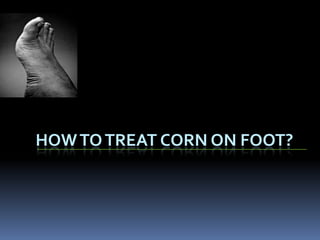 HOW TO TREAT CORN ON FOOT?
 