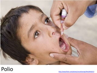 Polio   http://www.flickr.com/photos/unicefsverige/4415954257/
 