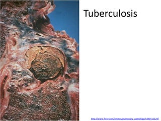 Tuberculosis




 http://www.flickr.com/photos/pulmonary_pathology/5390415129/
 