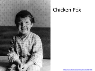 Chicken Pox




    http://www.flickr.com/photos/mricon/1837263/
 