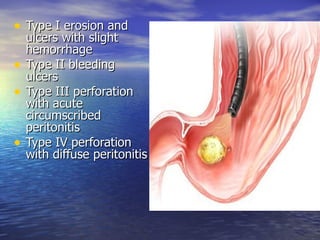 • Type I erosion and
    ulcers with slight
    hemorrhage
•   Type II bleeding
    ulcers
•   Type III perforation
    with acute
    circumscribed
    peritonitis
•   Type IV perforation
    with diffuse peritonitis
 