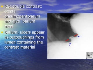 • RG: double contrast:
  create
  pneumoperitoneum
  and give barium
  meal
• Barium: ulcers appear
  as outpouchings from
  lumen containing the
  contrast material
 