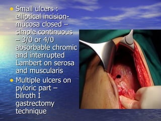 • Small ulcers :
  elliptical incision-
  mucosa closed –
  simple continuous
  – 3/0 or 4/0
  absorbable chromic
  and interrupted
  Lambert on serosa
  and muscularis
• Multiple ulcers on
  pyloric part –
  bilroth I
  gastrectomy
  technique
 