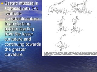 • Gastric mucosa is
 apposed with 3-0
 synthetic
 absorbable suture
 in an Cushing
 pattern starting
 from the lesser
 curvature and
 continuing towards
 the greater
 curvature
 