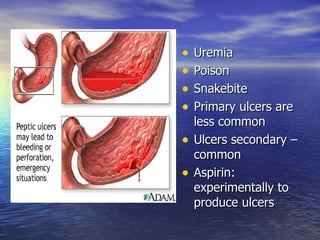 •   Uremia
•   Poison
•   Snakebite
•   Primary ulcers are
    less common
•   Ulcers secondary –
    common
•   Aspirin:
    experimentally to
    produce ulcers
 