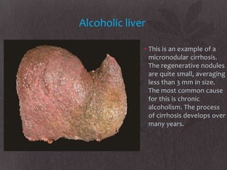 Alcoholic liver

              • This is an example of a
                micronodular cirrhosis.
                The regenerative nodules
                are quite small, averaging
                less than 3 mm in size.
                The most common cause
                for this is chronic
                alcoholism. The process
                of cirrhosis develops over
                many years.
 