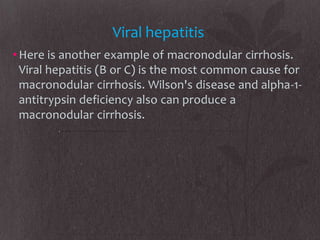 Viral hepatitis
• Here is another example of macronodular cirrhosis.
  Viral hepatitis (B or C) is the most common cause for
  macronodular cirrhosis. Wilson's disease and alpha-1-
  antitrypsin deficiency also can produce a
  macronodular cirrhosis.
 