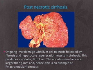 Post necrotic cirrhosis




• Ongoing liver damage with liver cell necrosis followed by
  fibrosis and hepatocyte regeneration results in cirrhosis. This
  produces a nodular, firm liver. The nodules seen here are
  larger than 3 mm and, hence, this is an example of
  "macronodular" cirrhosis
 