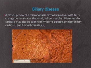 Biliary disease
• A close-up view of a micronodular cirrhosis in a liver with fatty
  change demonstrates the small, yellow nodules. Micronodular
  cirrhosis may also be seen with Wilson's disease, primary biliary
  cirrhosis, and hemochromatosis.
 