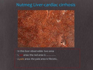 Nutmeg Liver-cardiac cirrhosis




• In this liver observable two area
• 1.red area: the red area is ………..
• 2.pale area: the pale area is fibrotic.
 
