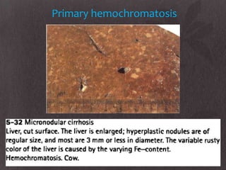 Primary hemochromatosis
 